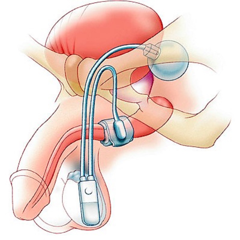 Erkekte yapay sfinkter