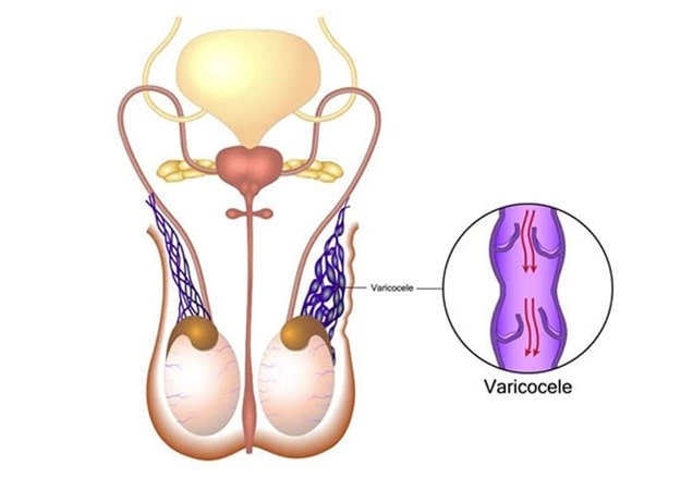 Mikrocerrahi Varikoselektomi