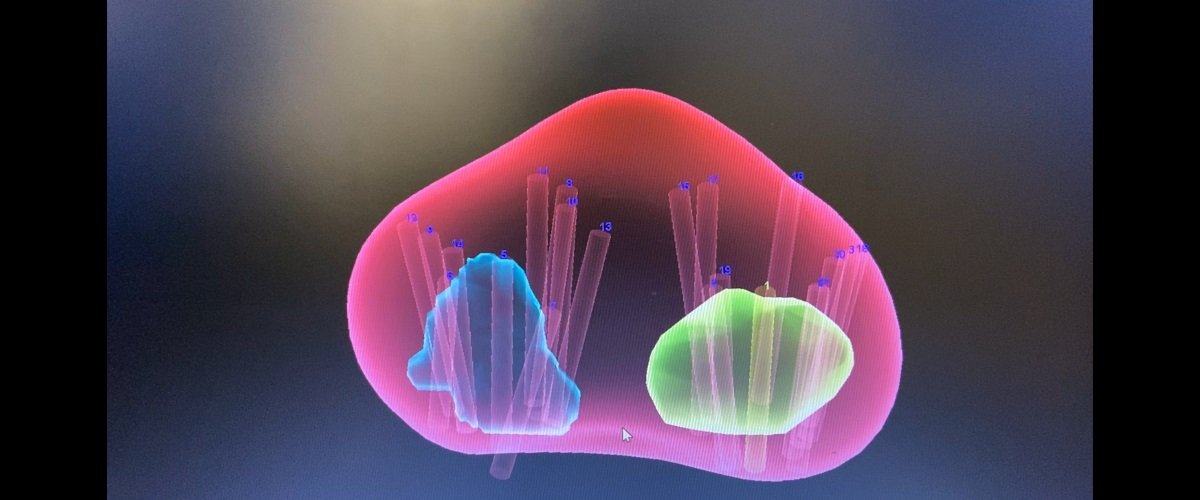 MR Füzyon Prostat Biyopsi