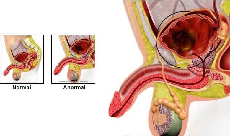 Mesane (İdrar Torbası) Kanseri